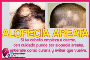 como curar la alopecia areata, cura definitiva